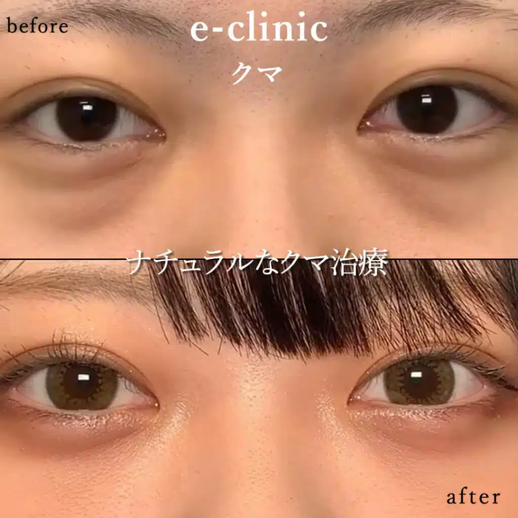 クマ取り_脂肪注入の症例写真