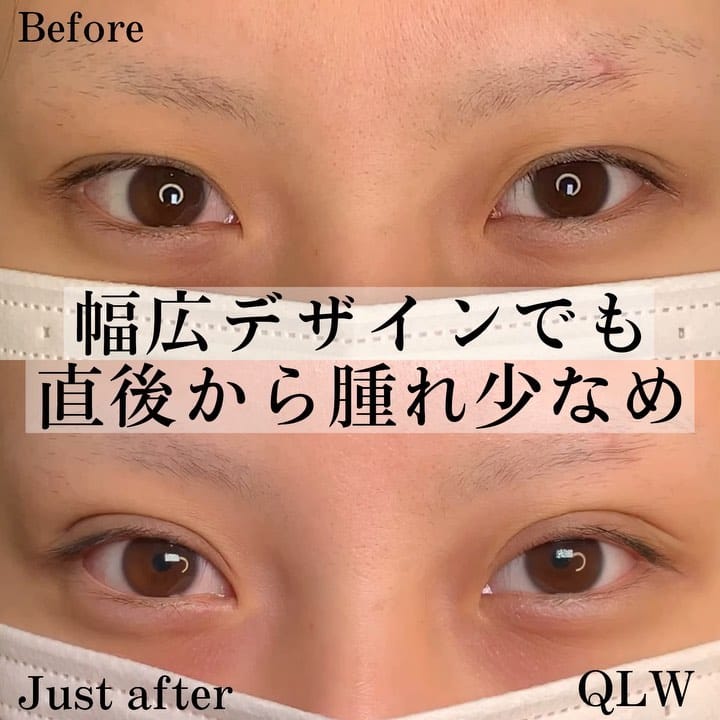 eclinic那覇院の二重埋没法(クイックダブルループ法)