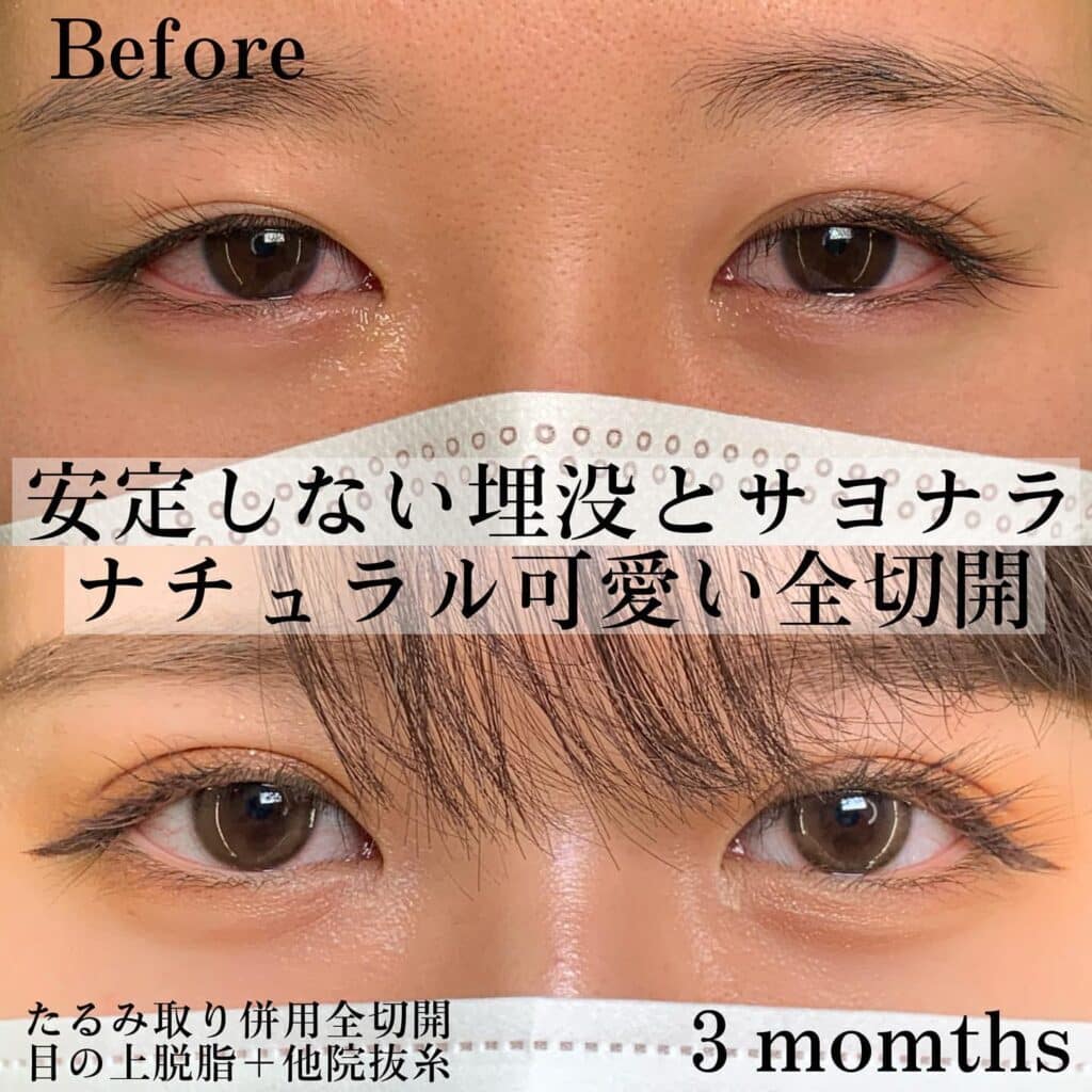 eclinic那覇院の全切開二重術+目の上脱脂+他院埋没抜糸