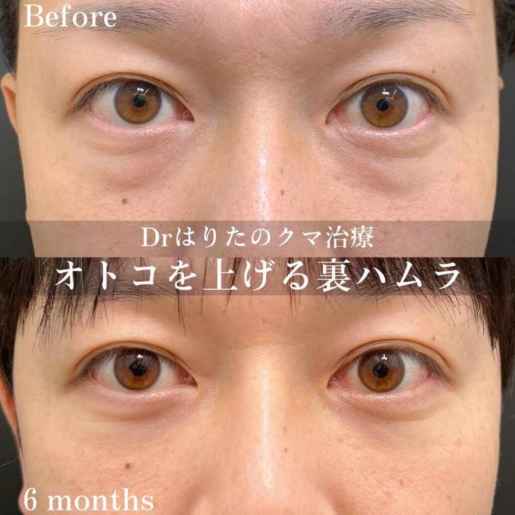 クマ取り_裏ハムラの症例写真（男性）
