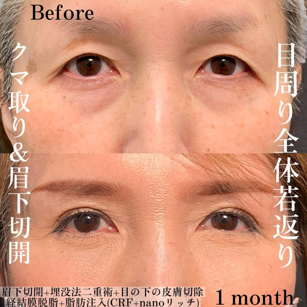 eクリニック那覇院の経結膜脱脂と脂肪注入と埋没法と眉下切開の症例写真（4）