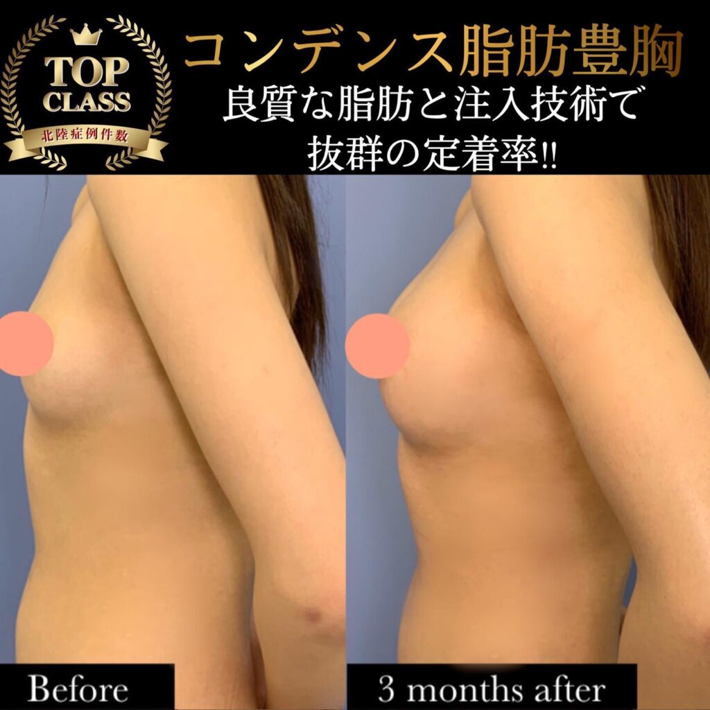 コンデンス脂肪豊胸の症例写真 (8)