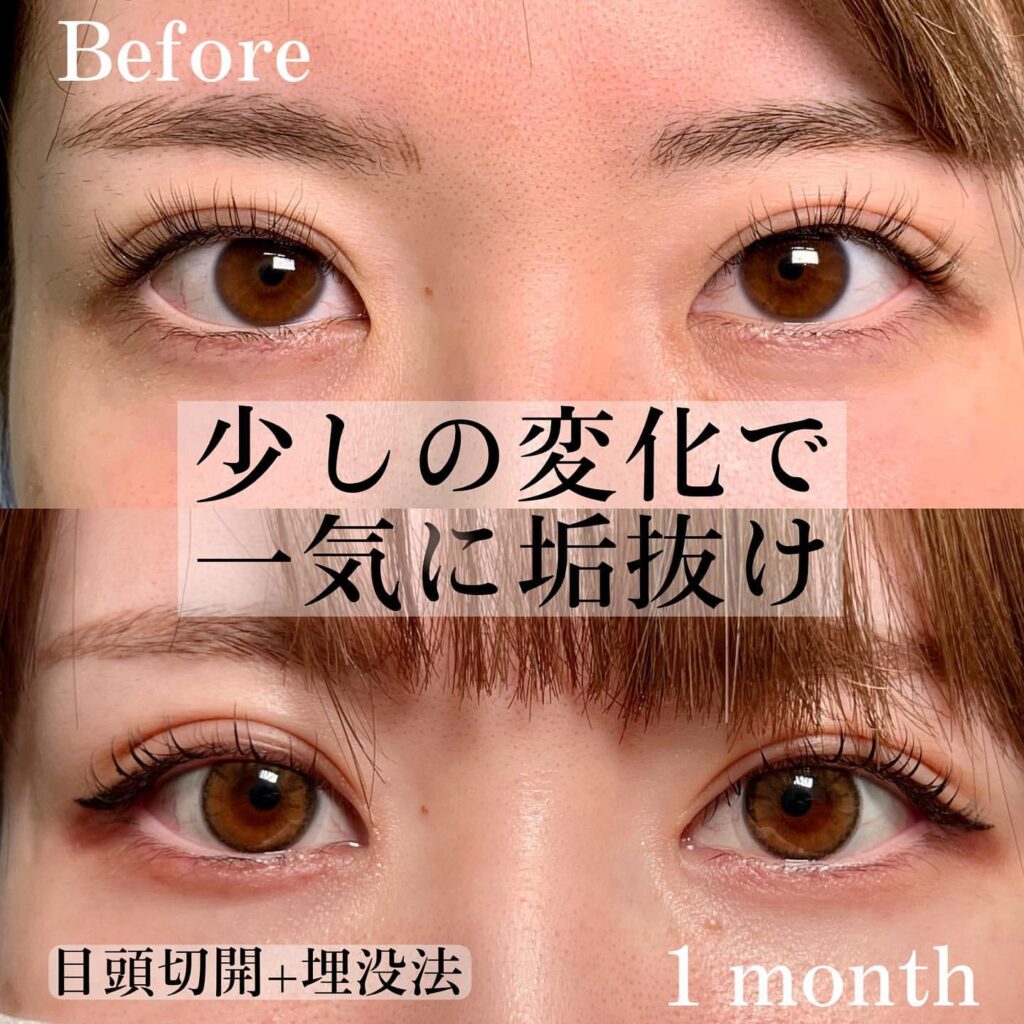 eclinic那覇院の目頭切開+埋没法