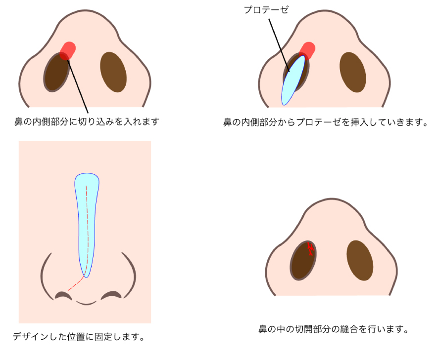 プロテーゼの挿入方法の図解