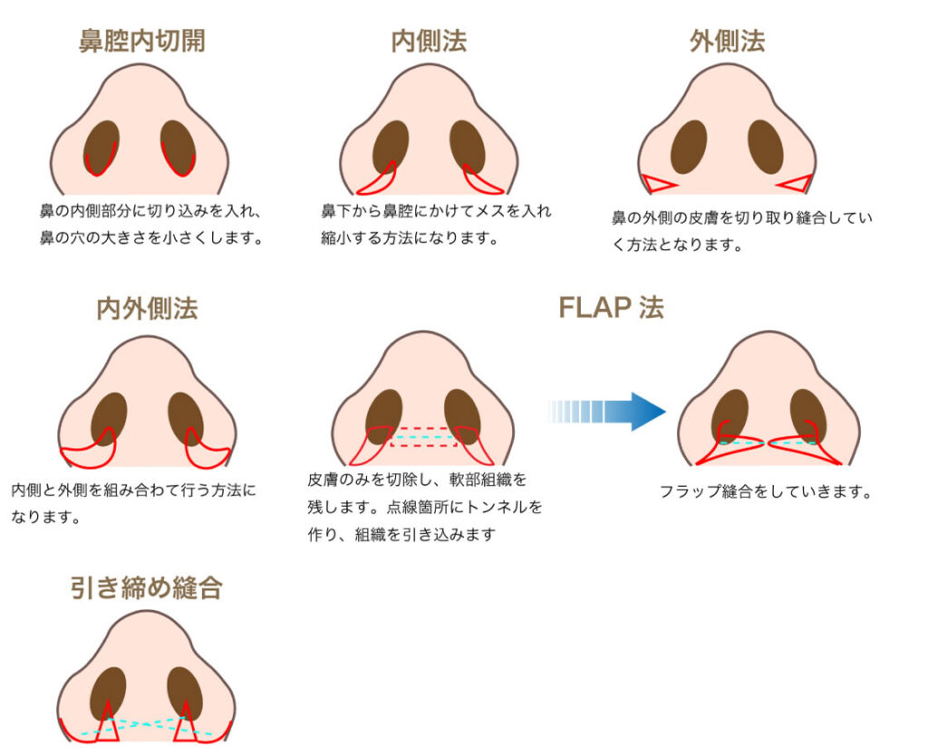 小鼻縮小の術式の図解