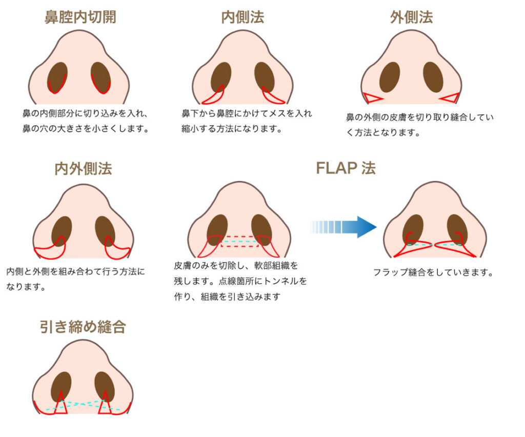 小鼻縮小の種類の図解