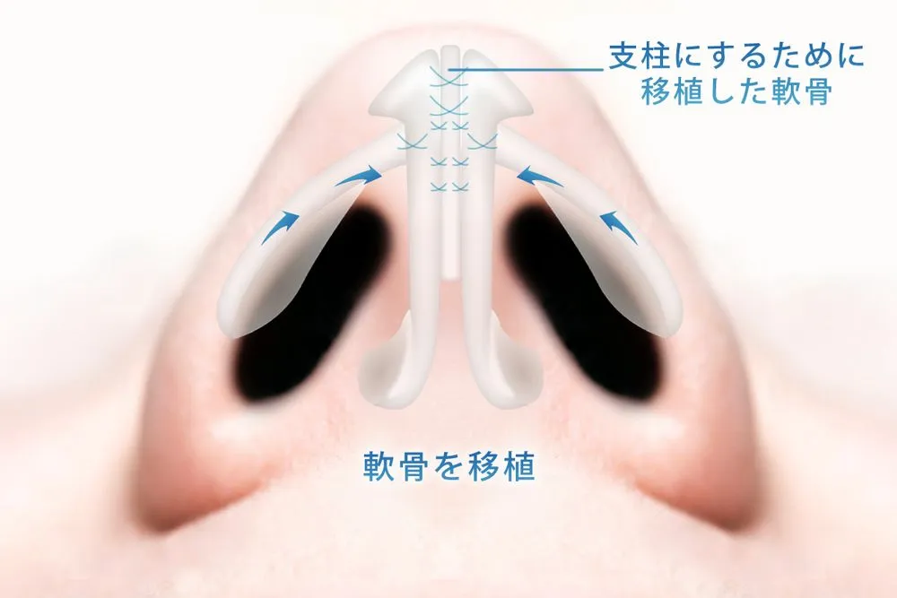 コルメラストラット法とターディ法の組み合わせの図解