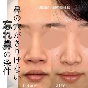 小鼻縮小と鼻中隔延長を受けた女性の症例写真