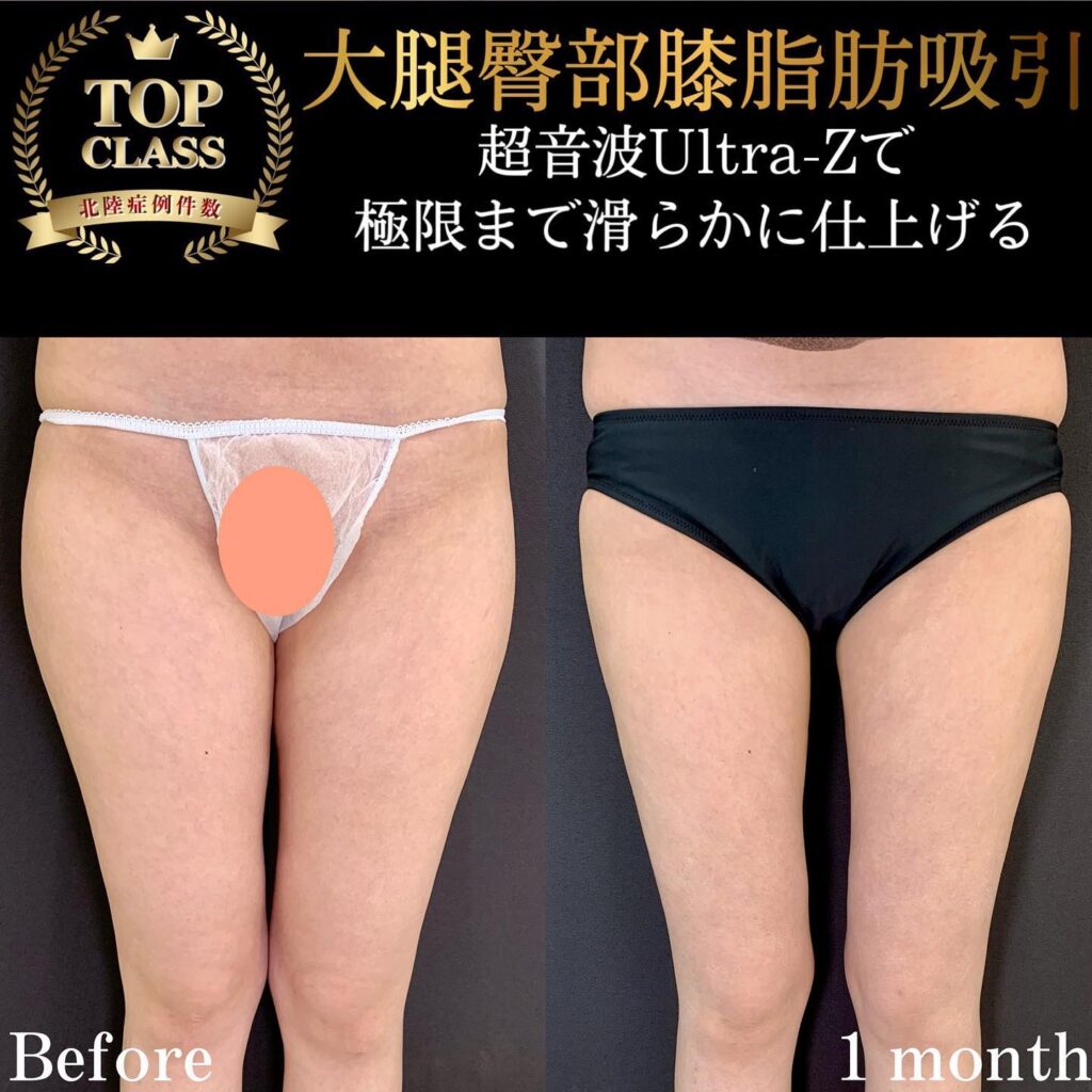 大腿臀部膝の脂肪吸引の症例写真 (1)