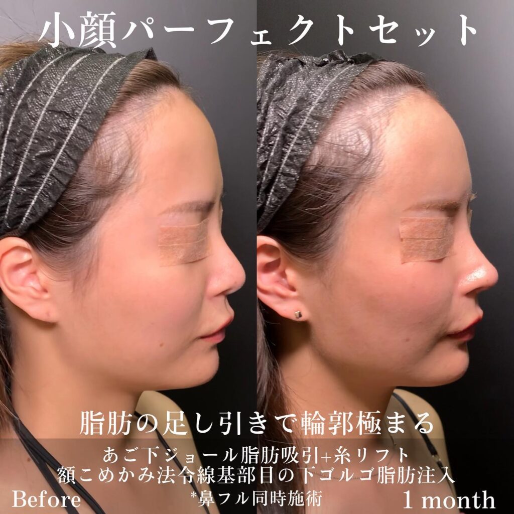 小顔パーフェクトセットの症例写真 (5)
