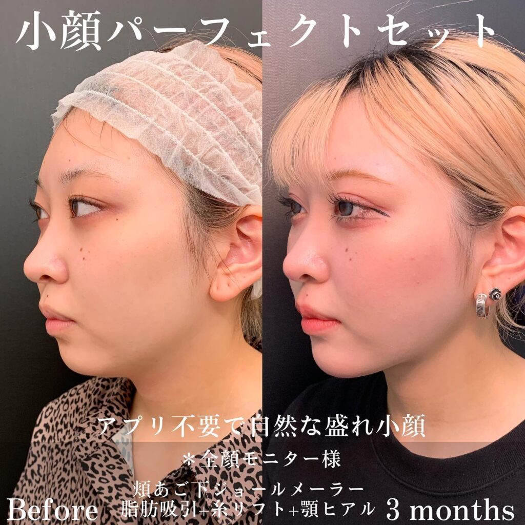 小顔パーフェクトセットの症例写真 (3)