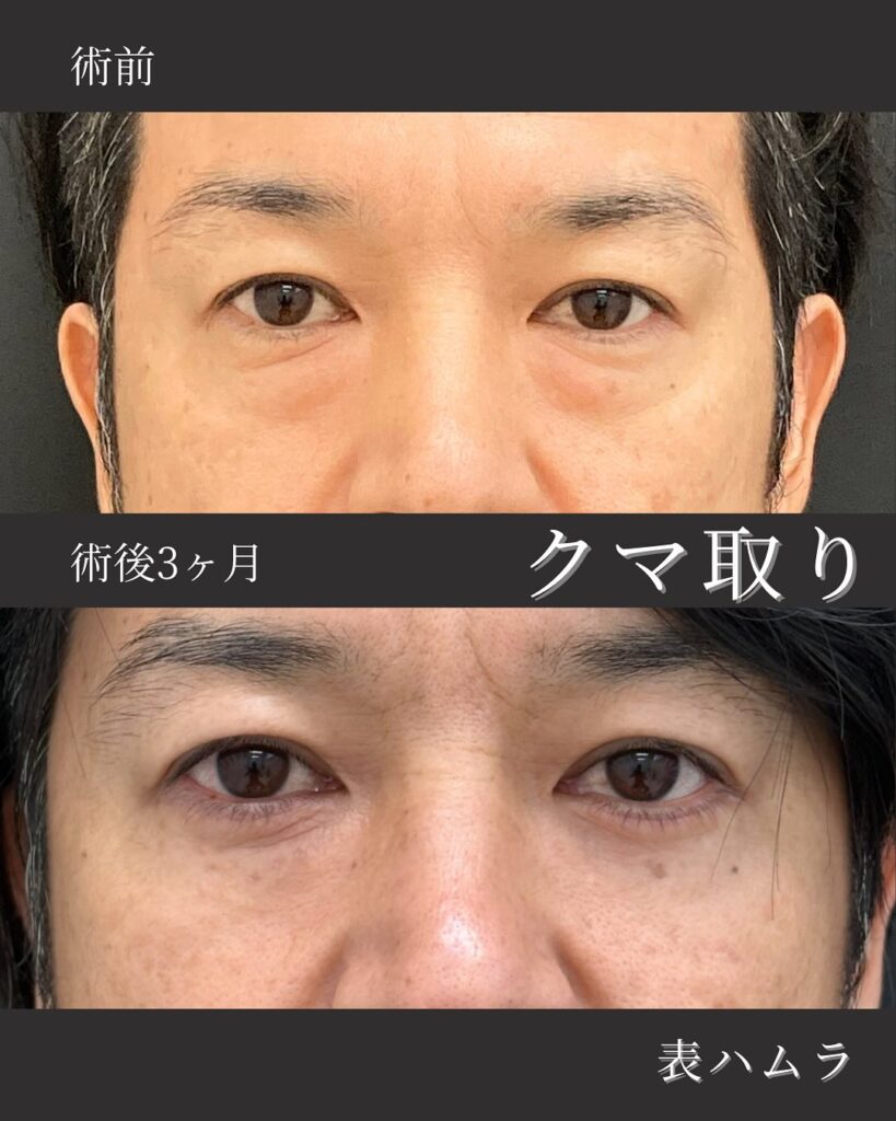 那覇院の表ハムラ法の症例写真 (1)
