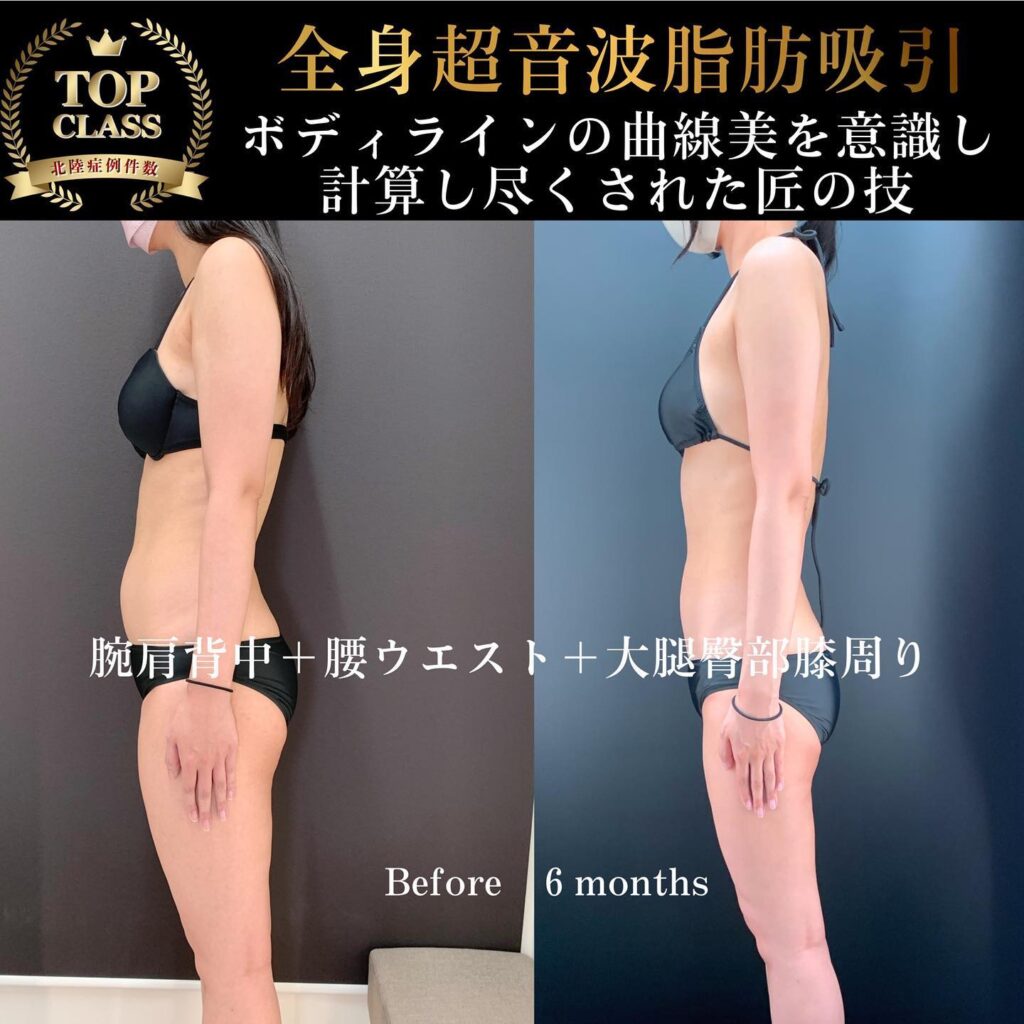 全身の超音波脂肪吸引の症例写真 (3)