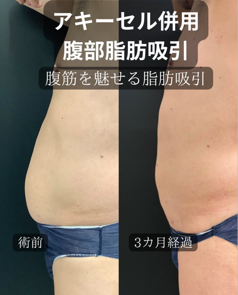 アキーセルを併用したお腹の脂肪吸引の症例写真 (2)