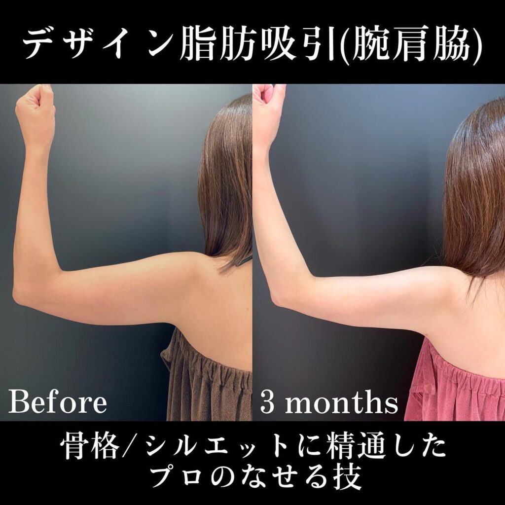 腕、肩、脇のデザイン脂肪吸引 (1)