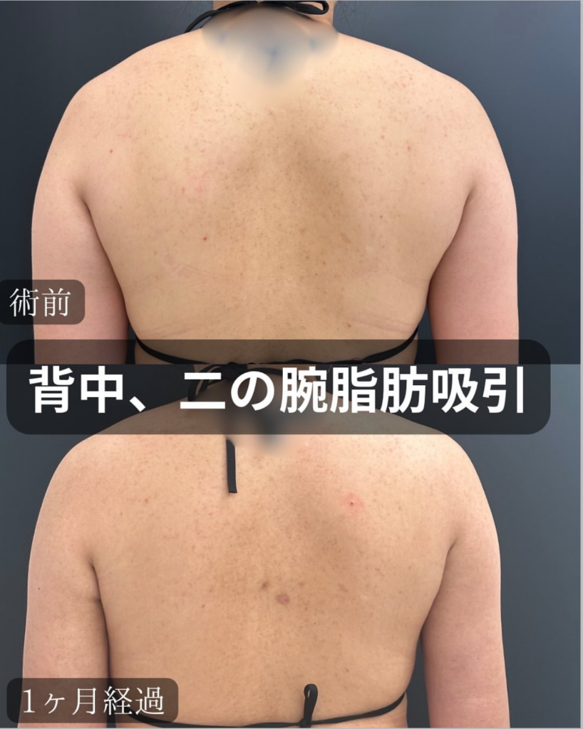 背中と二の腕の脂肪吸引の症例写真 (2)