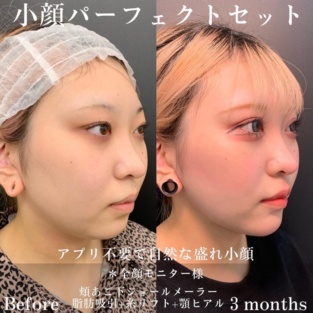 小顔パーフェクトセットの症例写真 (2)