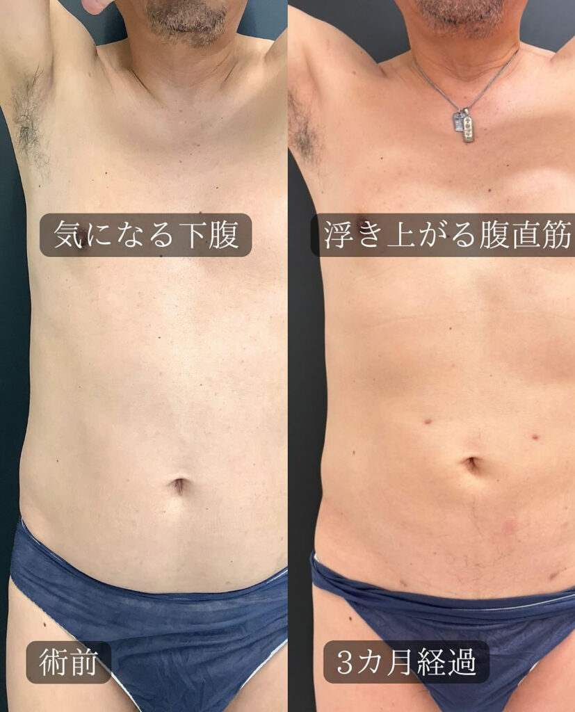 アキーセルを併用したお腹の脂肪吸引の症例写真 (2)_