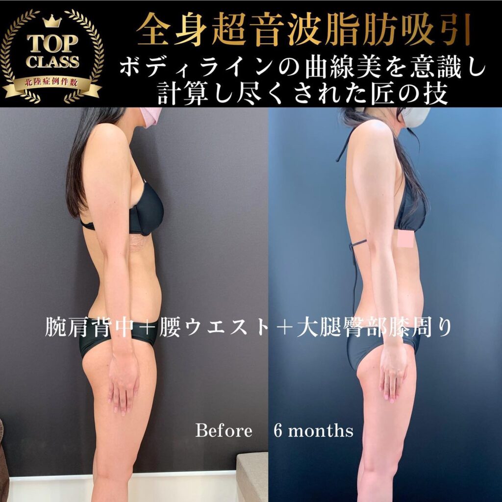 全身の超音波脂肪吸引の症例写真 (2)