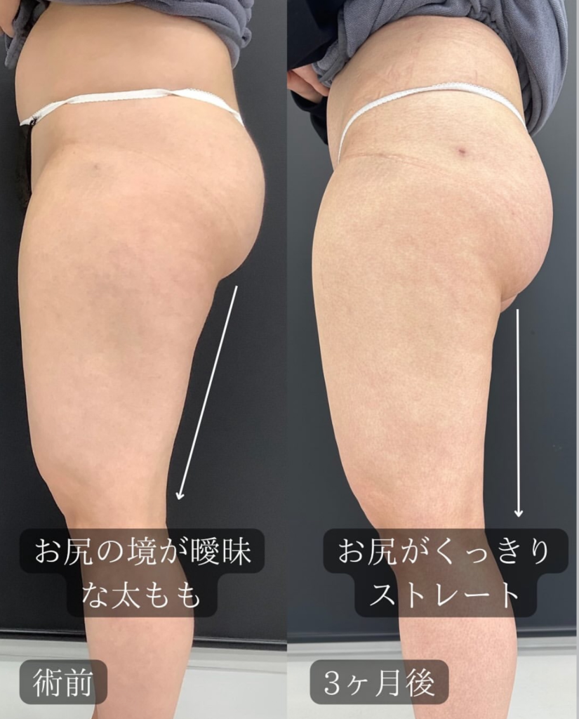 Ultra-Z併用大腿部脂肪吸引の症例写真 (3)