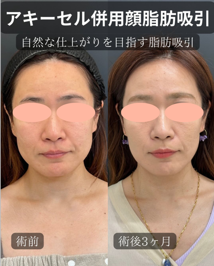 アキーセル併用した顔の脂肪吸の症例写真 (2)