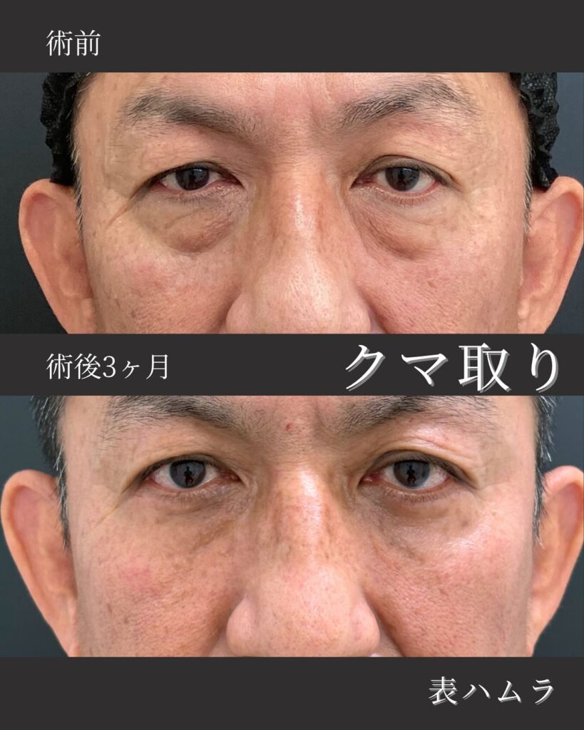 那覇院の表ハムラ法の症例写真