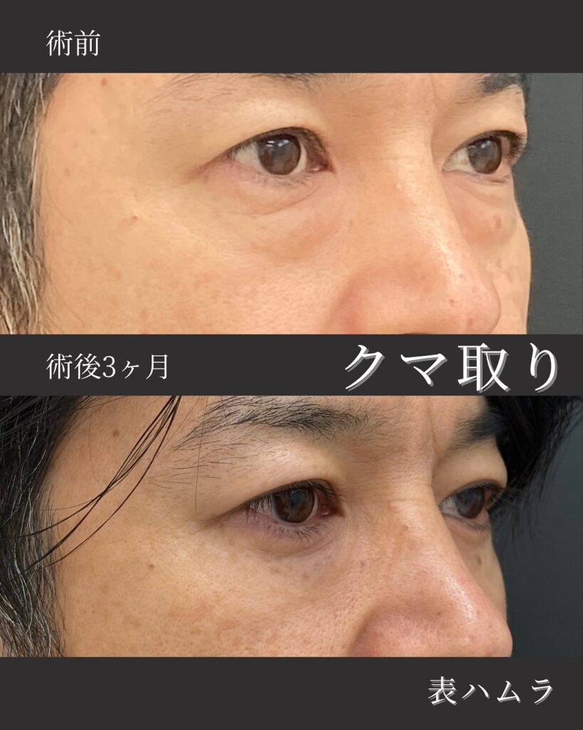 那覇院の表ハムラ法の症例写真 (3)