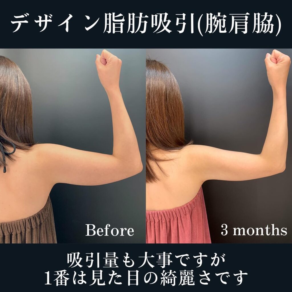 腕、肩、脇のデザイン脂肪吸引 (3)