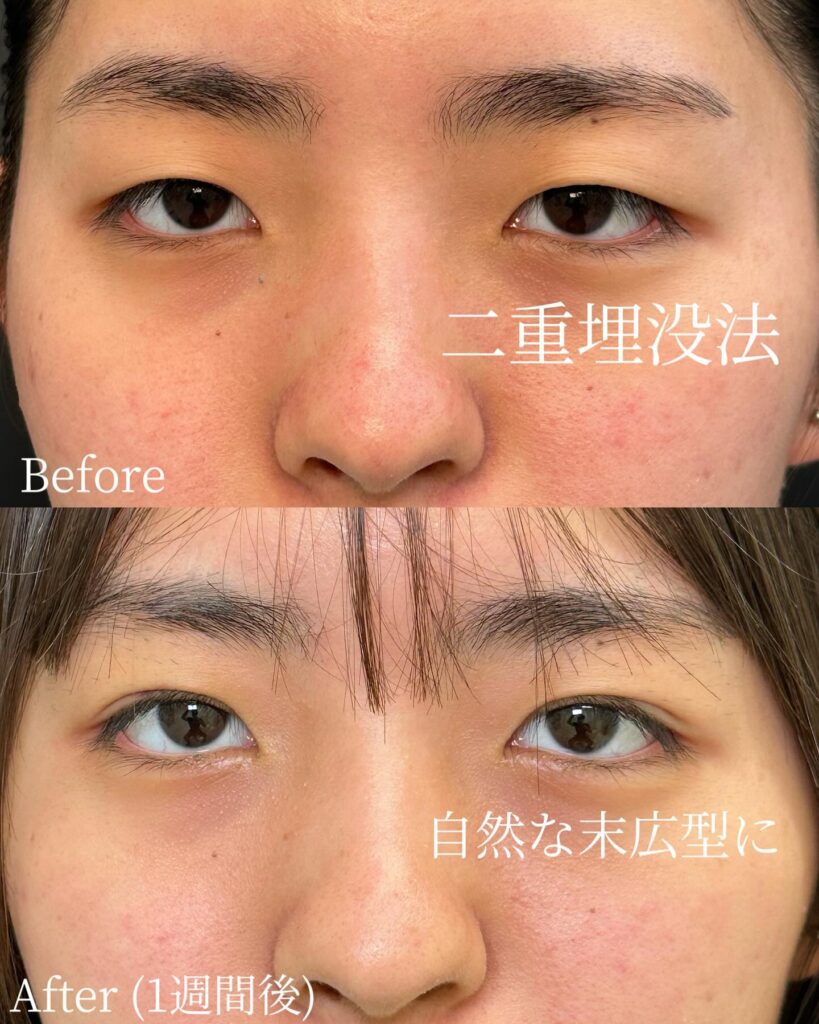 那覇院の埋没法の症例写真 (1)