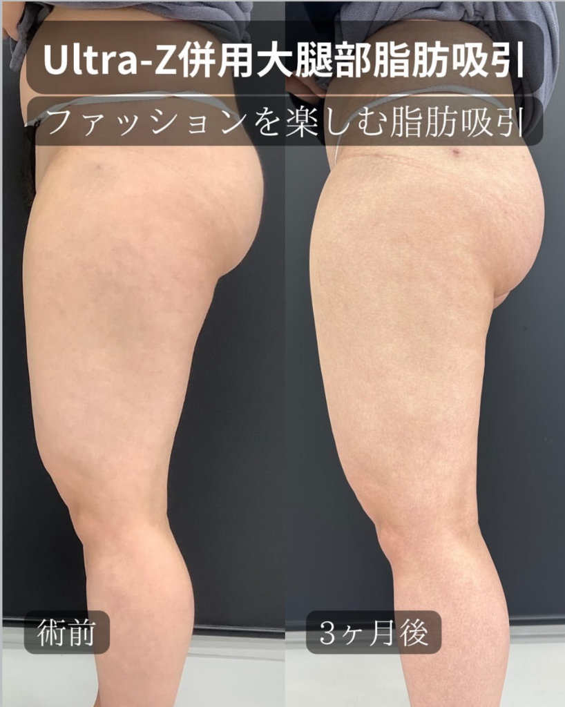 Ultra-Z併用大腿部脂肪吸引の症例写真 (2)