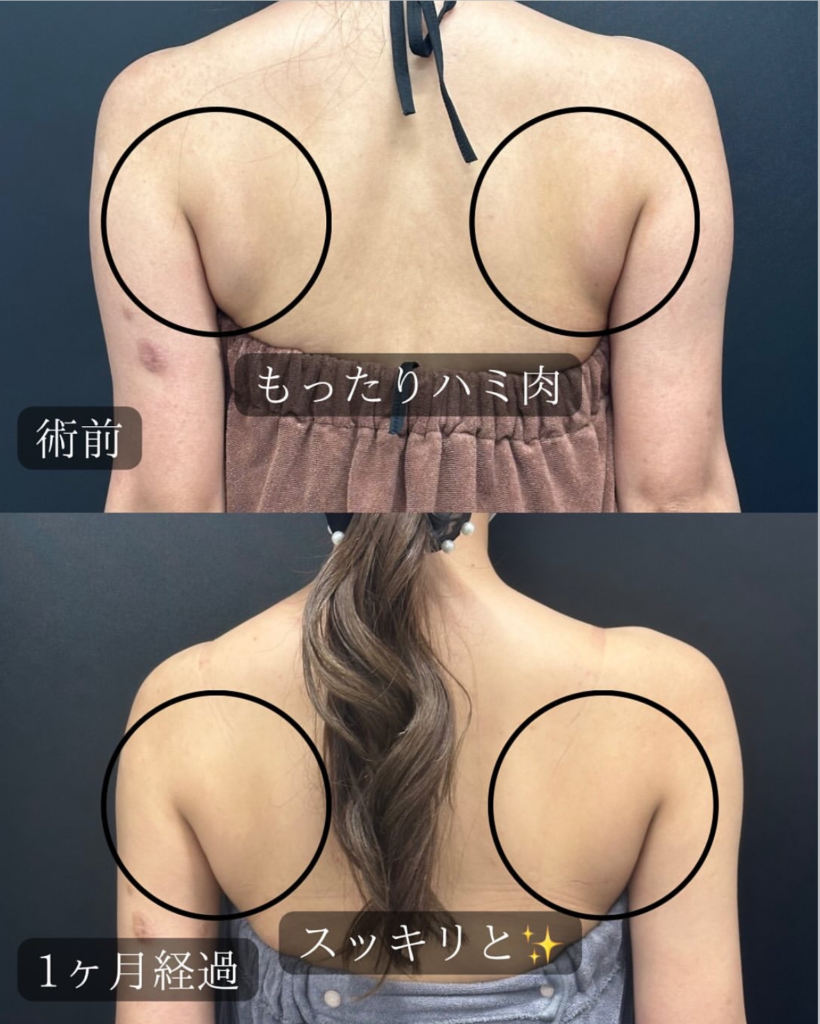 背中の脂肪吸引の症例写真 (1)