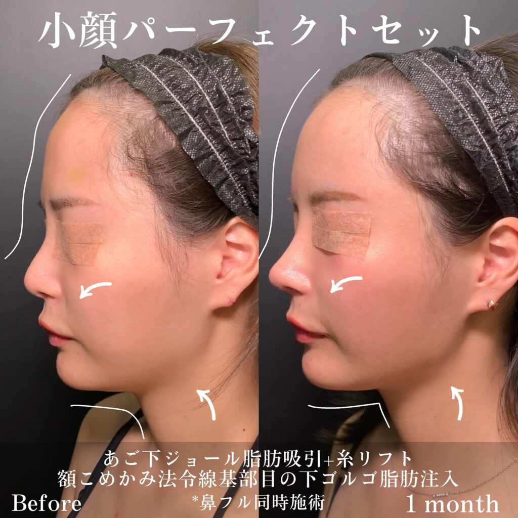 小顔パーフェクトセットの症例写真 (6)