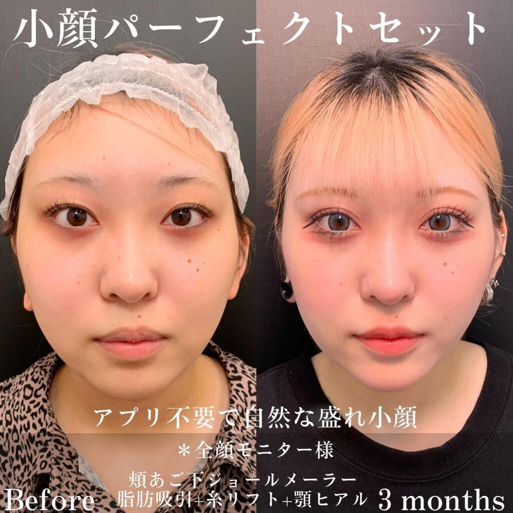 小顔パーフェクトセットの症例写真 (4)
