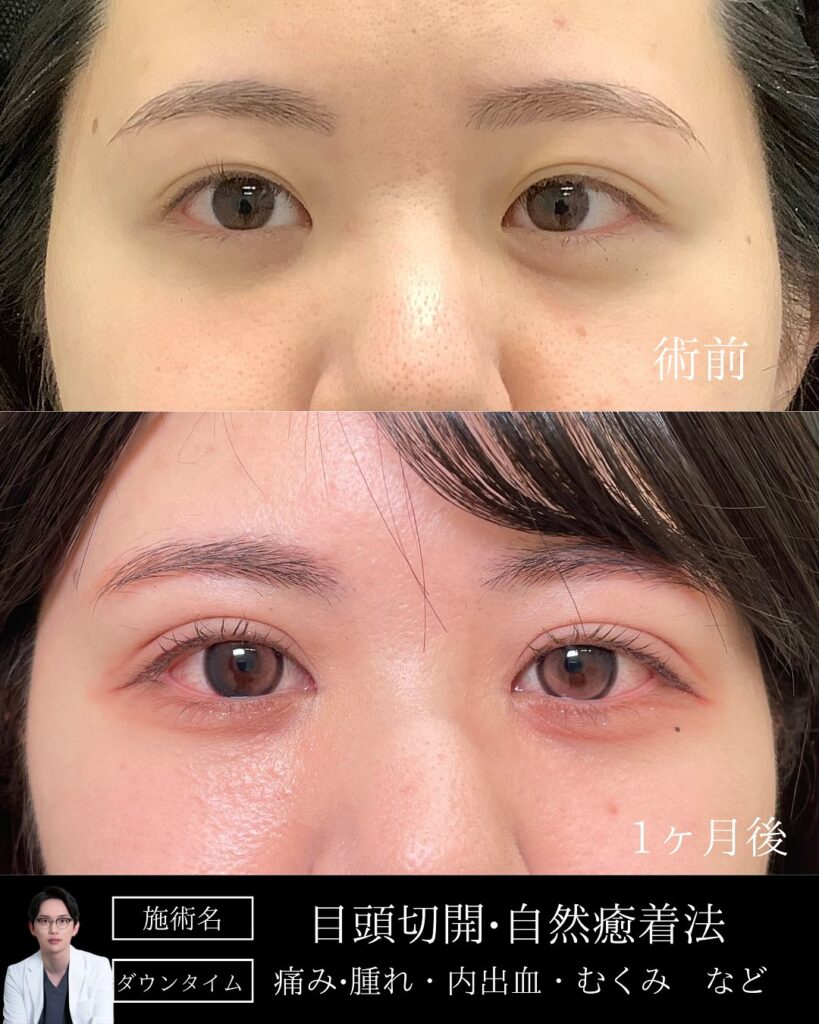 那覇院の目頭切開と自然癒着法の症例写真 (2)
