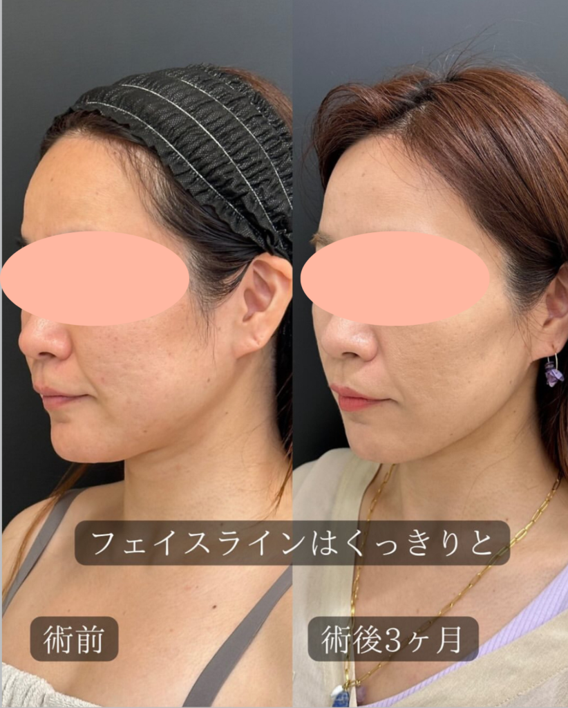 アキーセル併用した顔の脂肪吸の症例写真 (1)