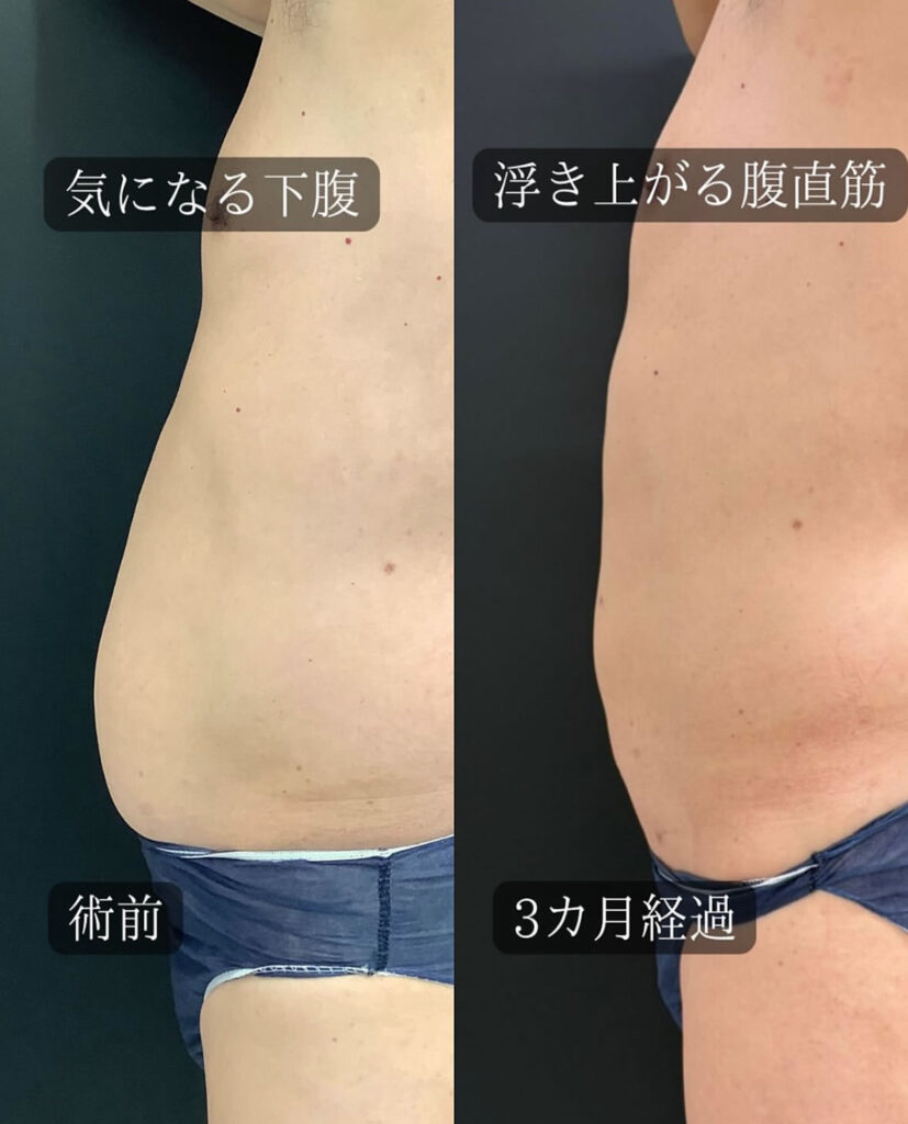 アキーセルを併用したお腹の脂肪吸引の症例写真