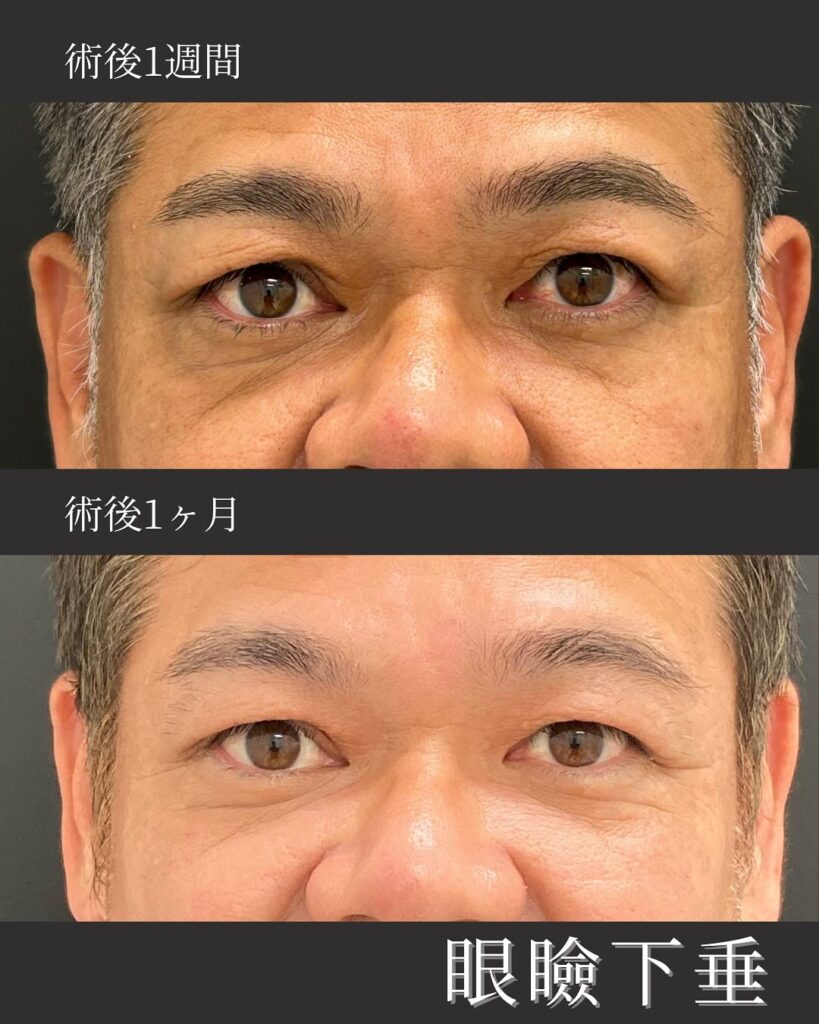 那覇院の眼瞼下垂の症例写真 (2)
