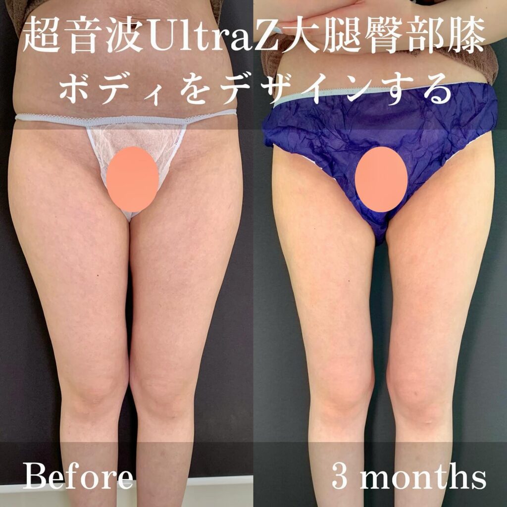 超音波UltraZ大腿臀部膝の症例写真 (3)