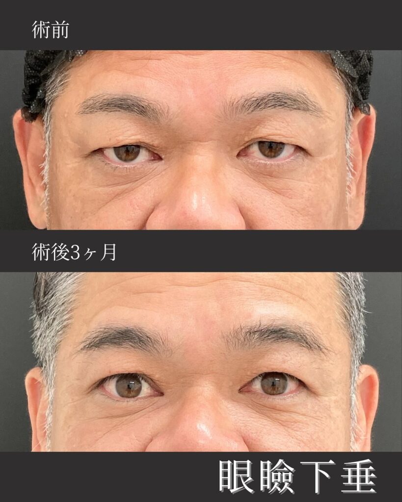那覇院の眼瞼下垂の症例写真 (1)