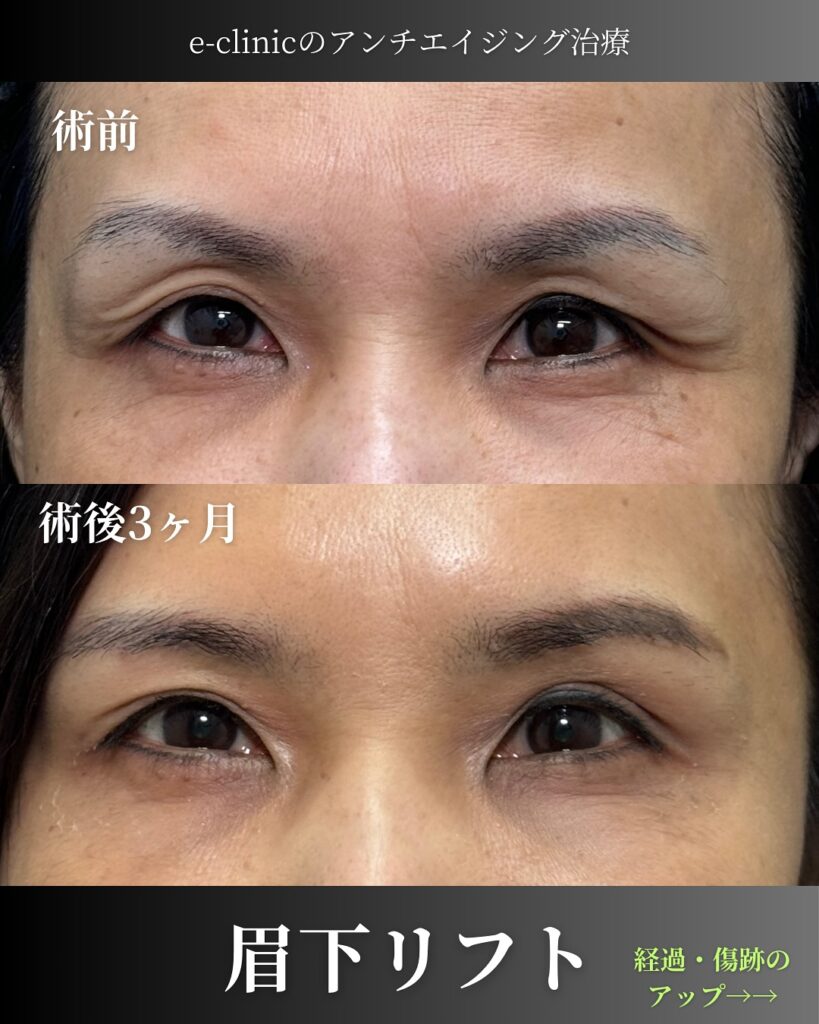 眉下リフトの症例写真 (1)