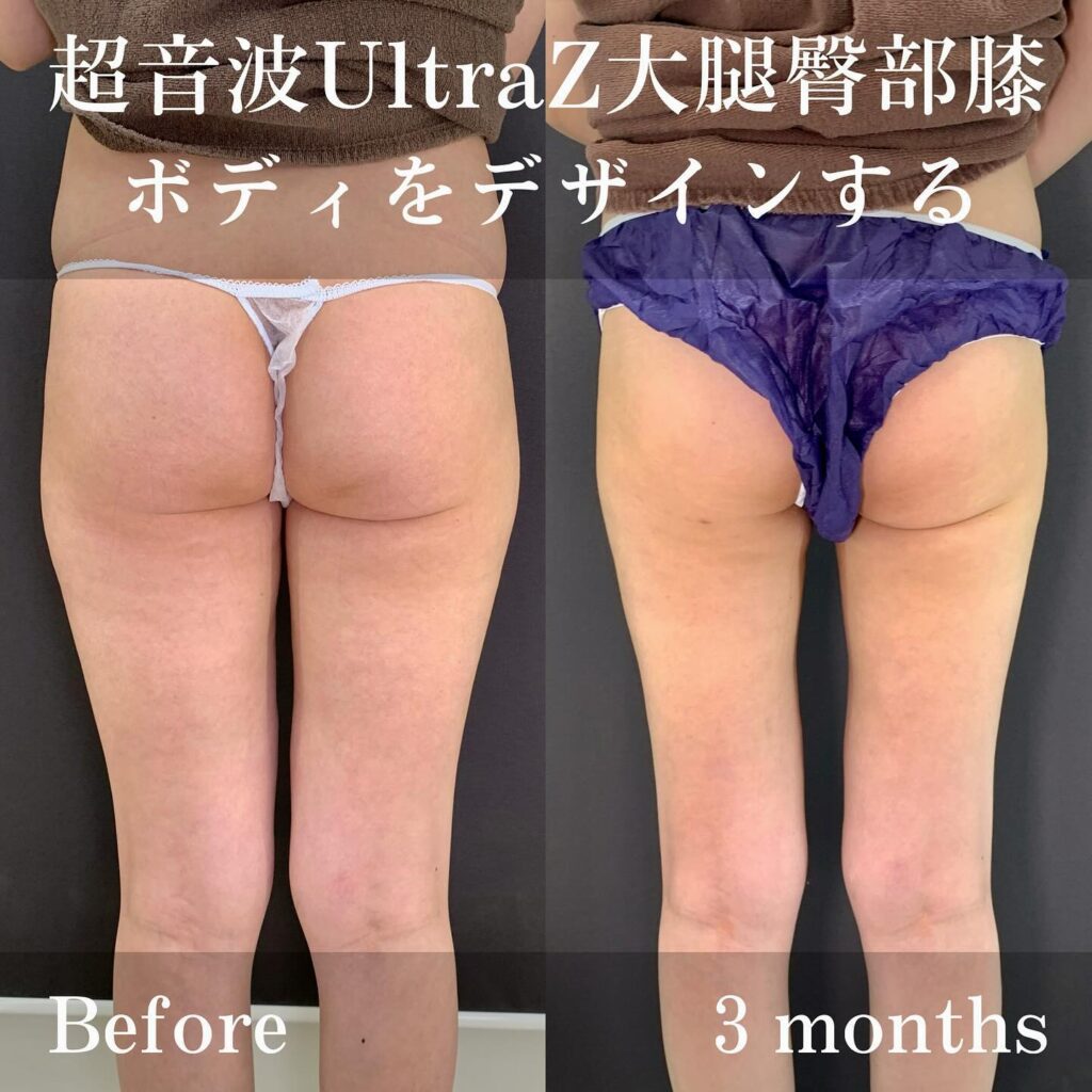 超音波UltraZ大腿臀部膝の症例写真 (2)