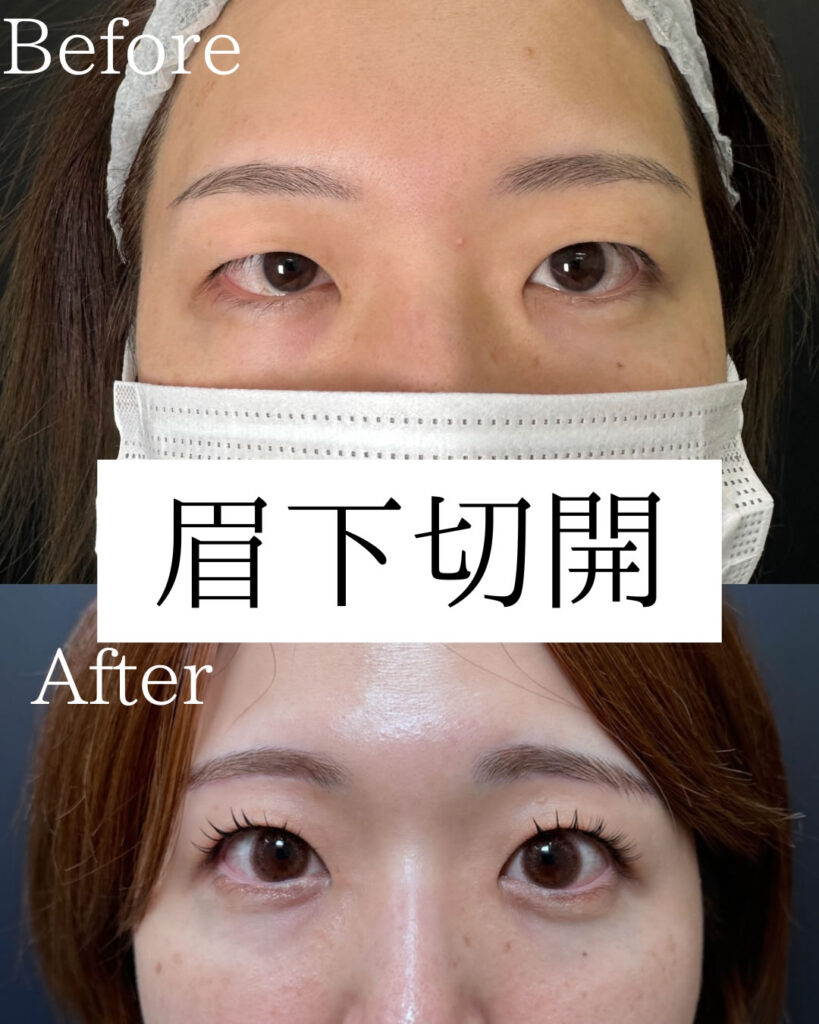 那覇院の眉下切開の症例写真