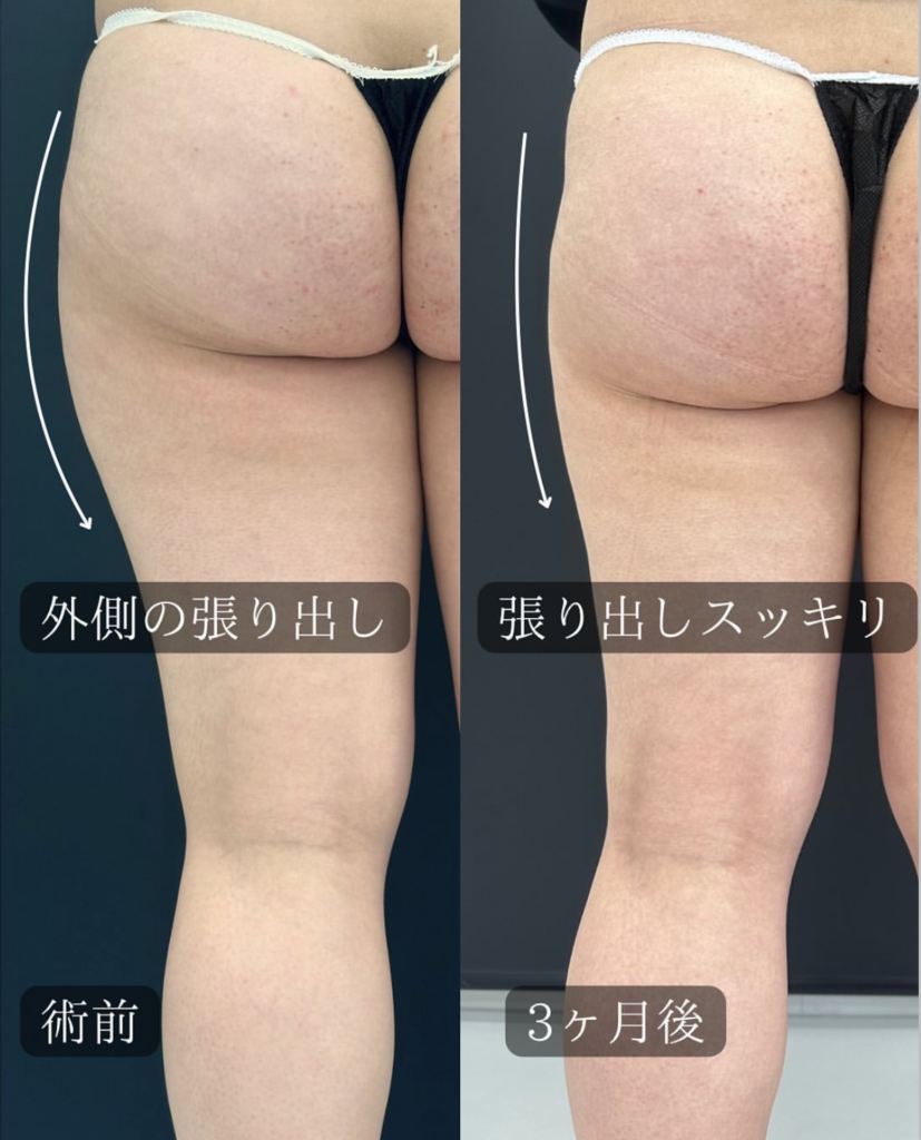 Ultra-Z併用大腿部脂肪吸引の症例写真 (1)