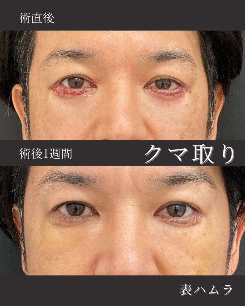 那覇院の表ハムラ法の症例写真 (2)