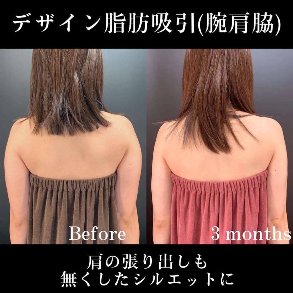 腕、肩、脇のデザイン脂肪吸引 (2)