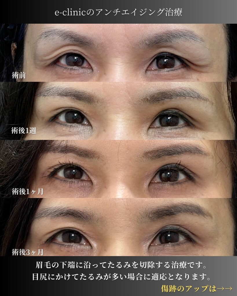 眉下リフトの症例写真 (3)