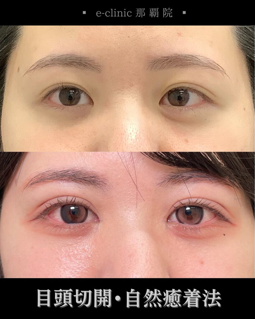 那覇院の目頭切開と自然癒着法の症例写真 (1)