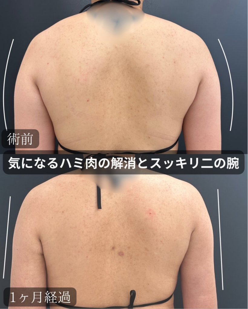 背中と二の腕の脂肪吸引の症例写真 (1)