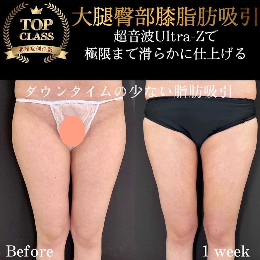 大腿臀部膝の脂肪吸引の症例写真 (2)