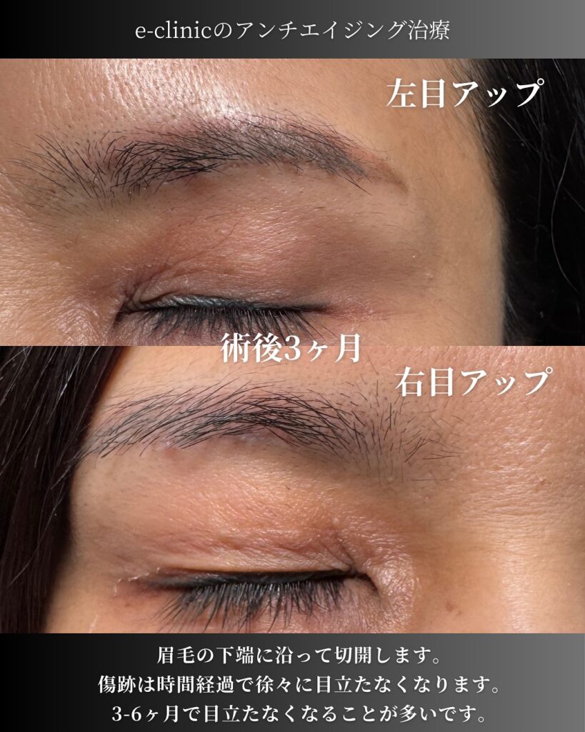 眉下リフトの症例写真 (2)